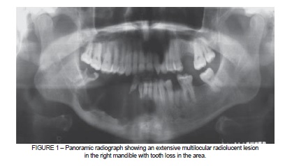 ameloblastoma x ray