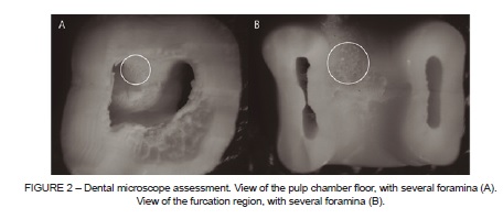 Dental Microscope As A Useful Tool To Detect Foramina In The